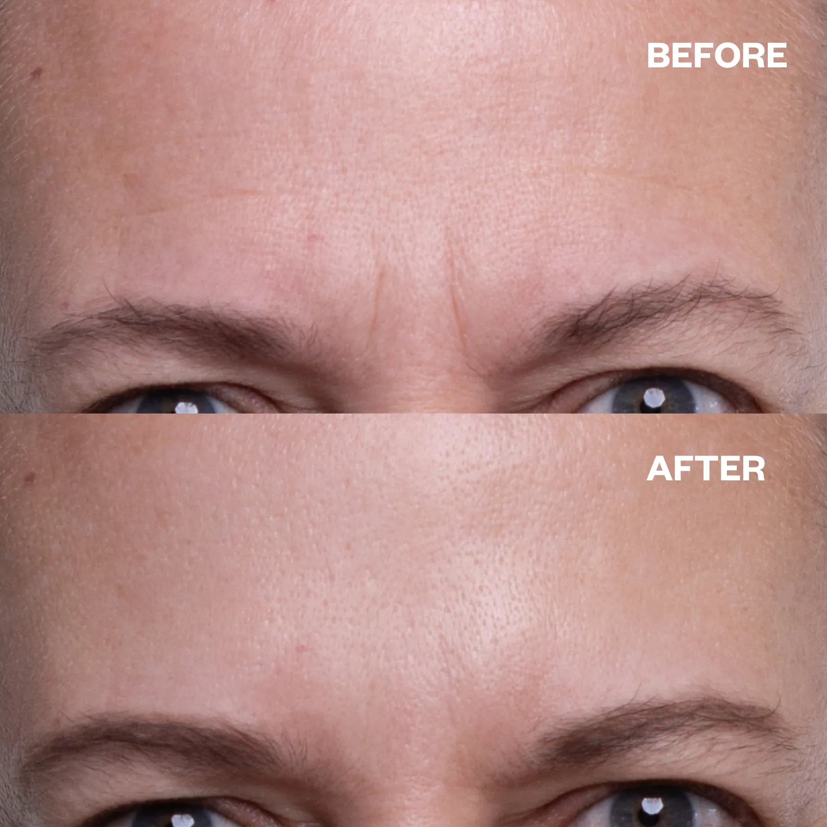 Forehead Wrinkle Patches - 2 Patches